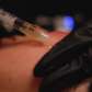 PRP Microneedling