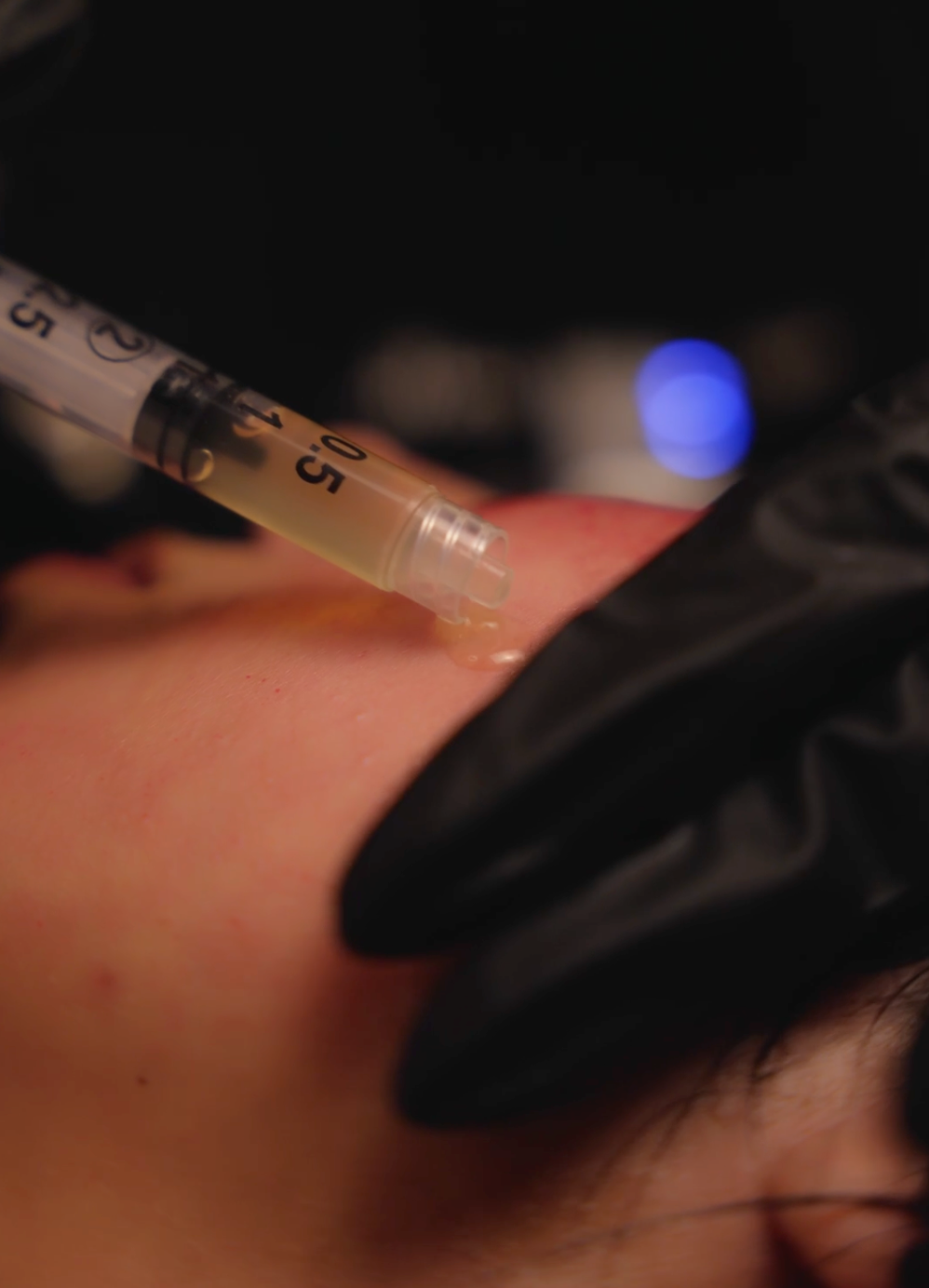 PRP Microneedling