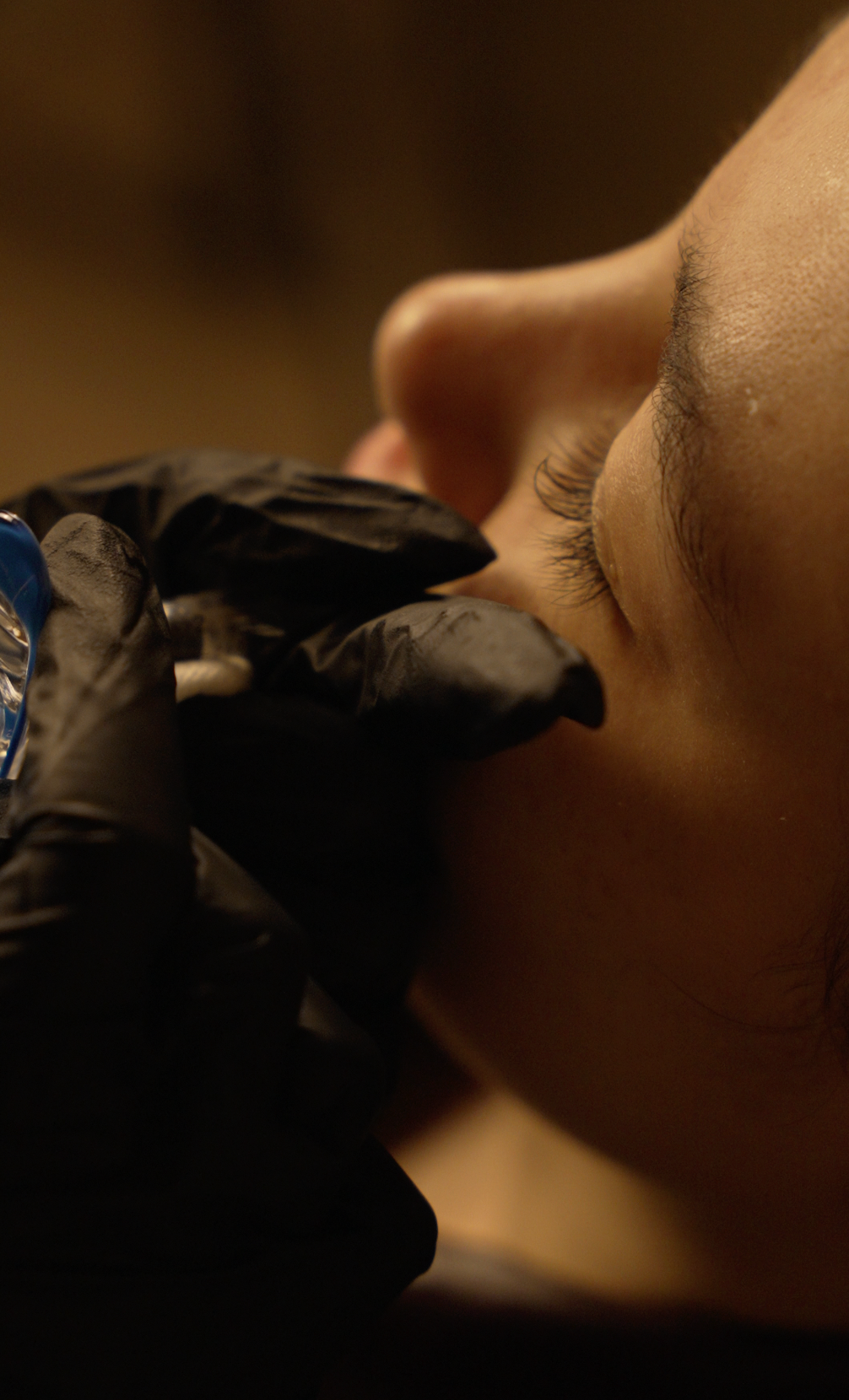 PRP Under Eye
