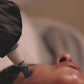 PRP Microneedling