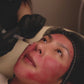PRP Microneedling
